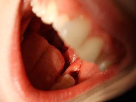 und da steckte der zahn mal..