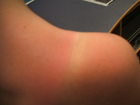 die sonne hinterläßt ihre spuren..