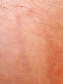 springhuhns oberschenkelnarbe