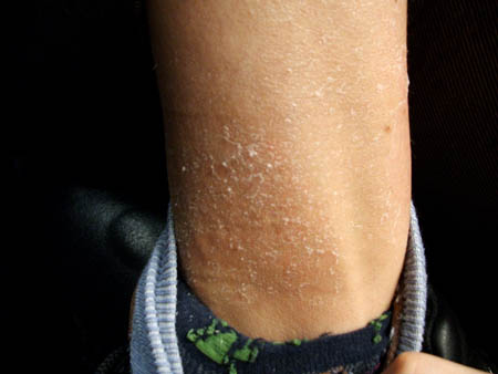 chrissys pellende haut..